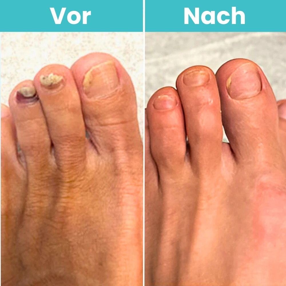 FungiClear Pro™ - Laser-Nagelpilz-Behandlung Gerät
