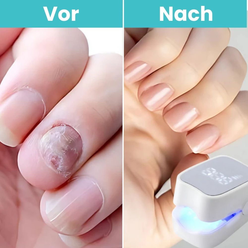 FungiClear Pro™ - Laser-Nagelpilz-Behandlung Gerät