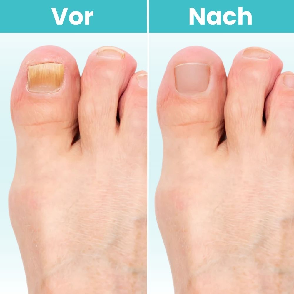 FungiClear Pro™ - Laser-Nagelpilz-Behandlung Gerät