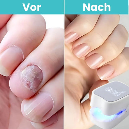 FungiClear Pro™ - Laser-Nagelpilz-Behandlung Gerät